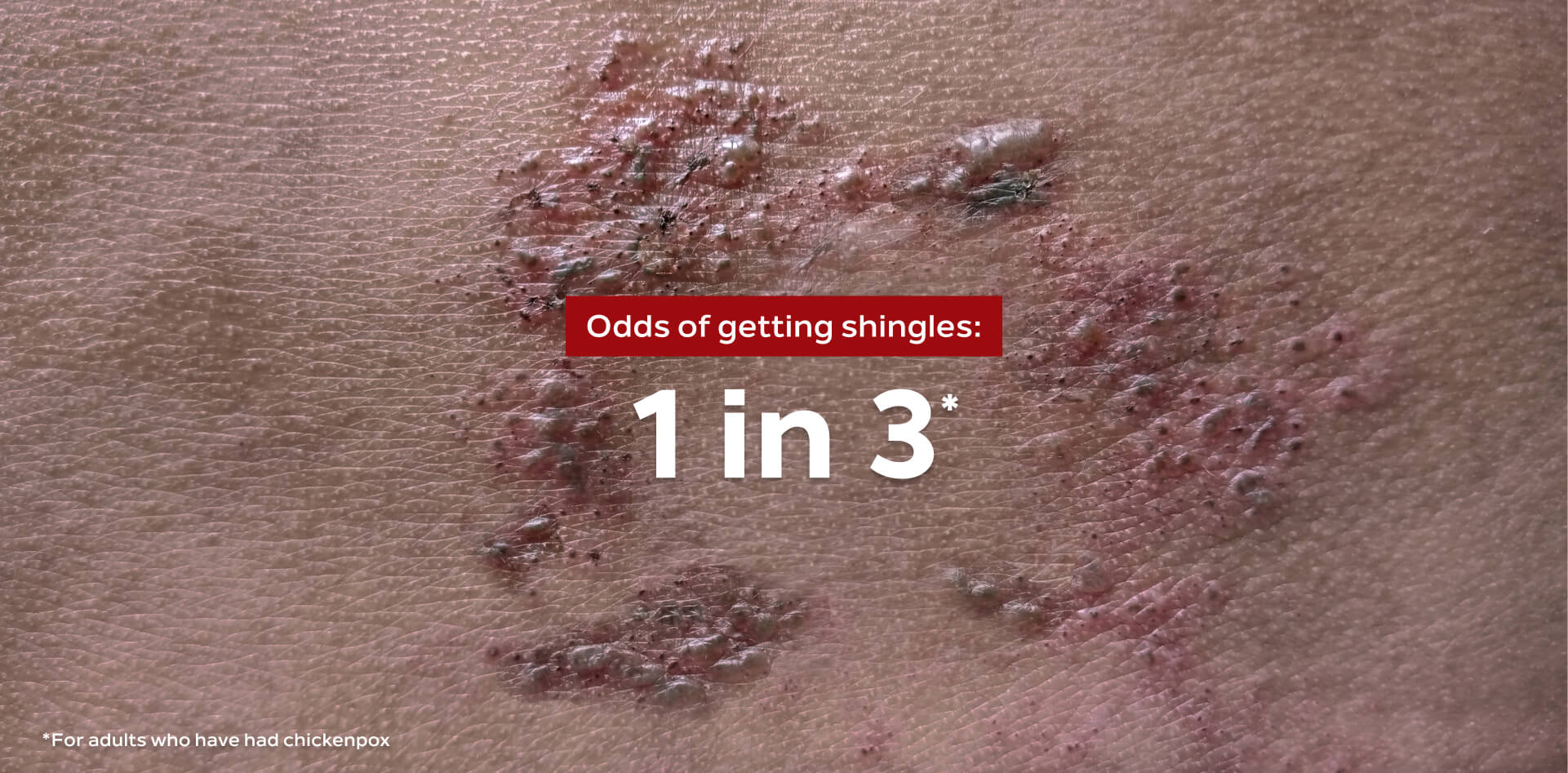 a picture showing the effects of Shingles on the skin