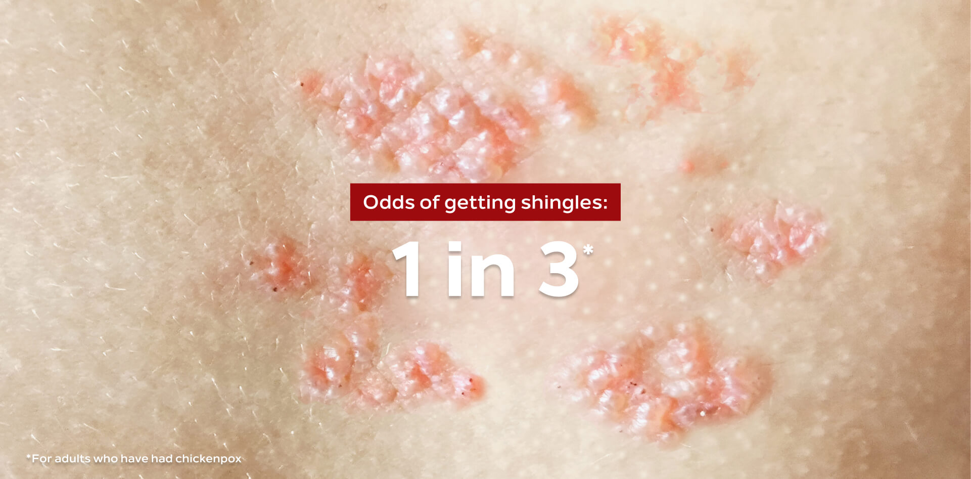 a picture showing the effects of Shingles on the skin.