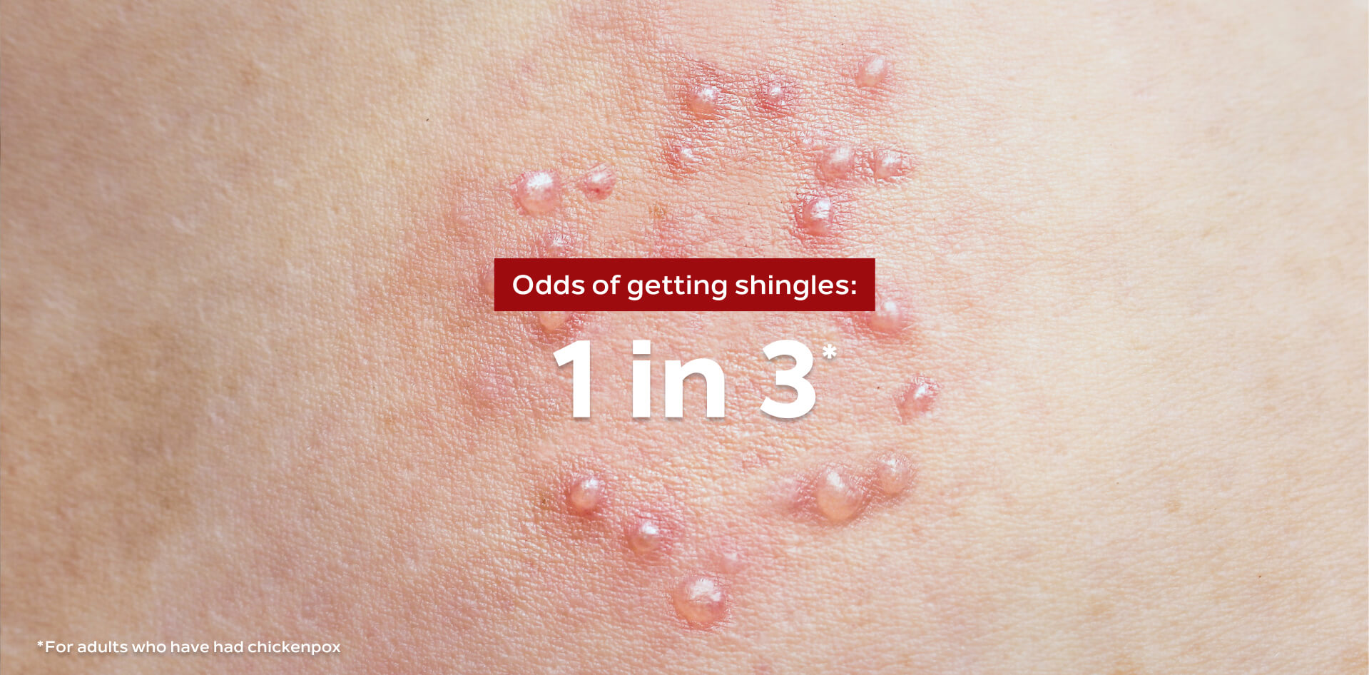 a picture showing the effects of Shingles on the skin.