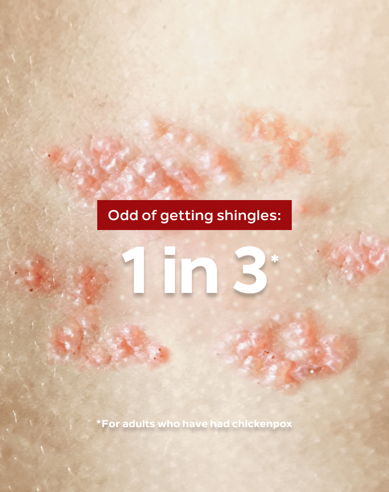 a picture showing the effects of Shingles on the skin.