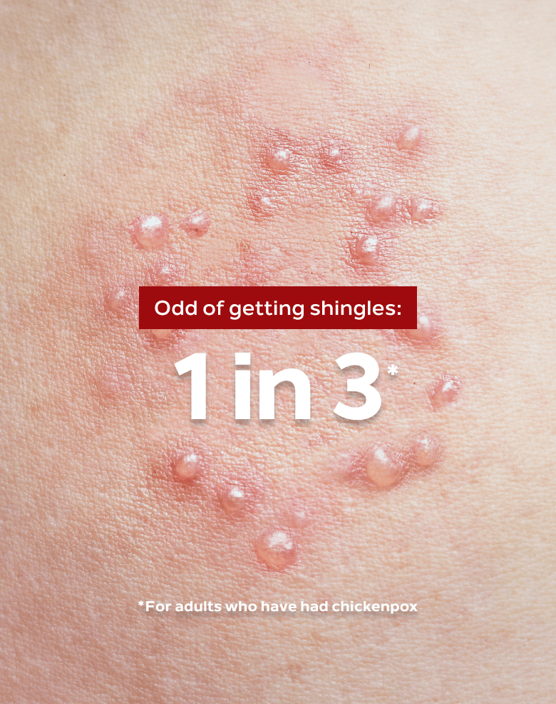 a picture showing the effects of Shingles on the skin.